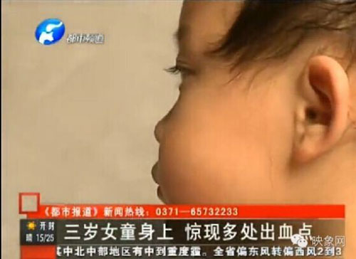 เด็กจีน 3 ขวบไตวาย หลังถูกครูอนุบาลฝังเข็ม ลงโทษไม่ยอมนอนกลางวัน เด็กจีน 3 ขวบไตวาย หลังถูกครูอนุบาลฝังเข็ม ลงโทษไม่ยอมนอนกลางวัน