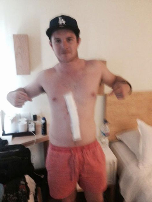 ขนลุก แมงมุมฝังตัวใต้ผิวหนังหนุ่มออสซี่ ขุดโพรงจนเป็นทางยาวแบบนี้ ขนลุก แมงมุมฝังตัวใต้ผิวหนังหนุ่มออสซี่ ขุดโพรงจนเป็นทางยาวแบบนี้