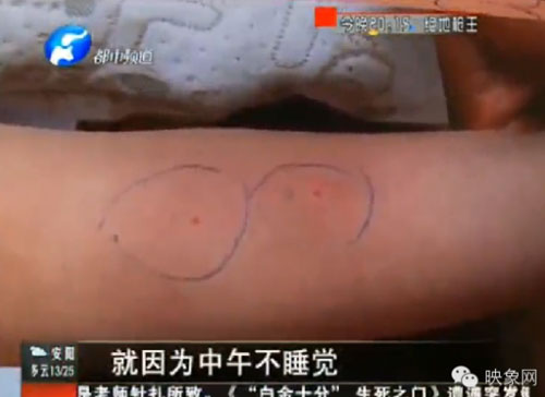 เด็กจีน 3 ขวบไตวาย หลังถูกครูอนุบาลฝังเข็ม ลงโทษไม่ยอมนอนกลางวัน เด็กจีน 3 ขวบไตวาย หลังถูกครูอนุบาลฝังเข็ม ลงโทษไม่ยอมนอนกลางวัน