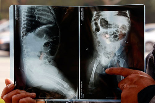 ป้าทารกจีนที่มีเข็มฝังในตัว ฆ่าตัวตายแล้ว สงสัยหนีความผิด ป้าทารกจีนที่มีเข็มฝังในตัว ฆ่าตัวตายแล้ว สงสัยหนีความผิด