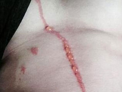 ขนลุก แมงมุมฝังตัวใต้ผิวหนังหนุ่มออสซี่ ขุดโพรงจนเป็นทางยาวแบบนี้ ขนลุก แมงมุมฝังตัวใต้ผิวหนังหนุ่มออสซี่ ขุดโพรงจนเป็นทางยาวแบบนี้