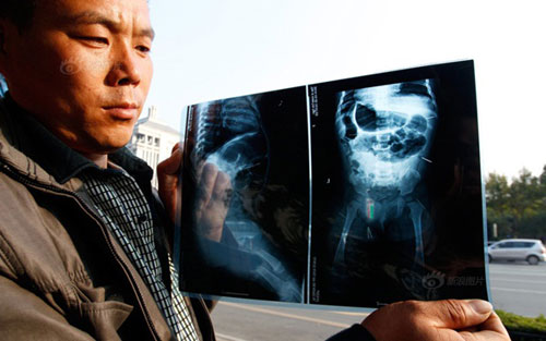 ป้าทารกจีนที่มีเข็มฝังในตัว ฆ่าตัวตายแล้ว สงสัยหนีความผิด ป้าทารกจีนที่มีเข็มฝังในตัว ฆ่าตัวตายแล้ว สงสัยหนีความผิด