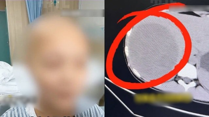 เด็กหญิงวัย 15 เป็นมะเร็งตับระยะสุดท้าย เด็กหญิงวัย 15 เป็นมะเร็งตับระยะสุดท้าย