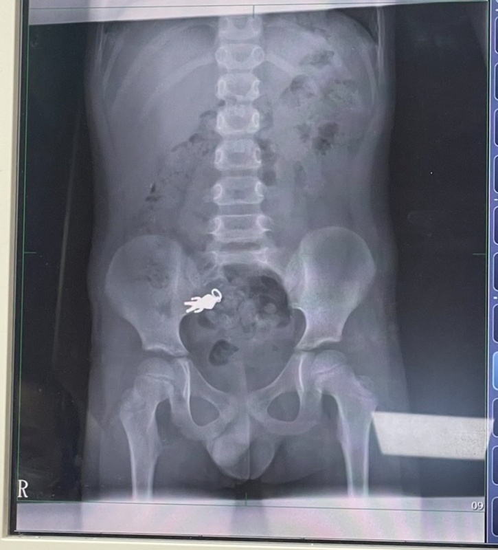 ภาพเอกซเรย์ช็อก ร่างมนุษย์จิ๋ว ภาพเอกซเรย์ช็อก ร่างมนุษย์จิ๋ว