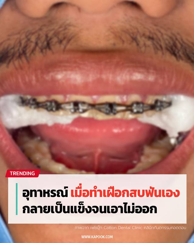 ทำเฝือกสบฟันเอง ทำเฝือกสบฟันเอง