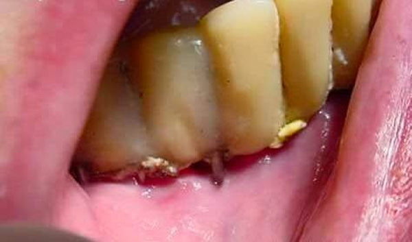 ฟันปลอมเถื่อน ฟันปลอมเถื่อน