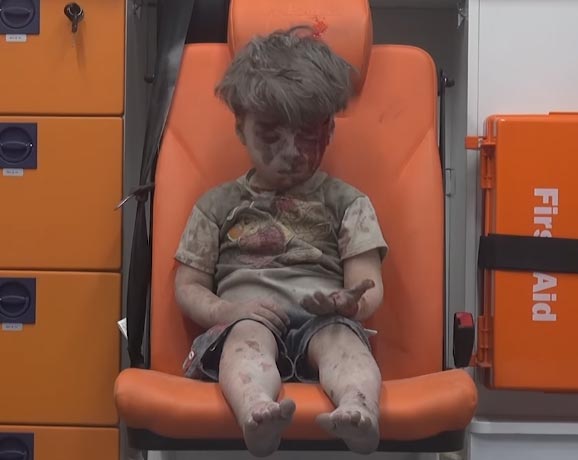 เด็กชาย 5 ขวบบาดเจ็บ-แววตาใสซื่อ ภาพสะท้อนเหยื่อบริสุทธิ์แห่งสงครามซีเรีย เด็กชาย 5 ขวบบาดเจ็บ-แววตาใสซื่อ ภาพสะท้อนเหยื่อบริสุทธิ์แห่งสงครามซีเรีย