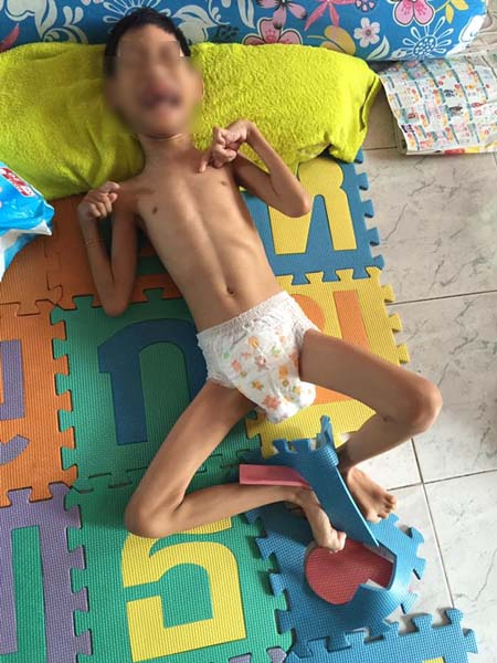 เด็ก 8 ขวบ หนัก 10 กิโลกรัม ป่วยสมองพิการ เด็ก 8 ขวบ หนัก 10 กิโลกรัม ป่วยสมองพิการ