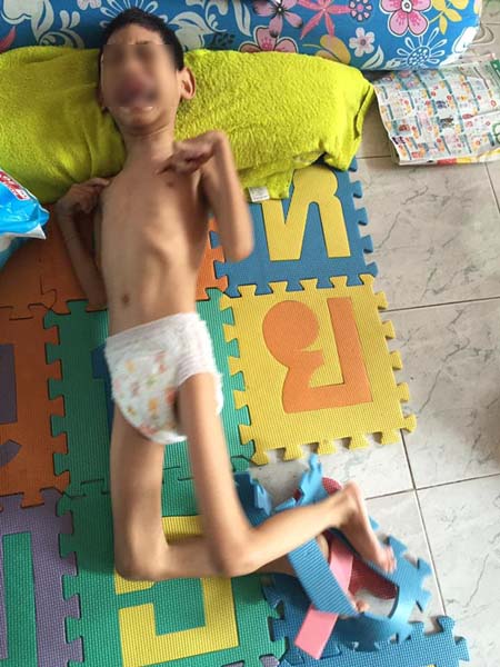 เด็ก 8 ขวบ หนัก 10 กิโลกรัม ป่วยสมองพิการ เด็ก 8 ขวบ หนัก 10 กิโลกรัม ป่วยสมองพิการ