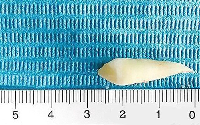 ฟันคุด ฟันคุด