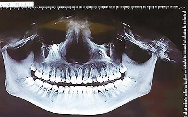 ฟันคุด ฟันคุด