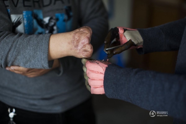 แขนเทียม แขนเทียม