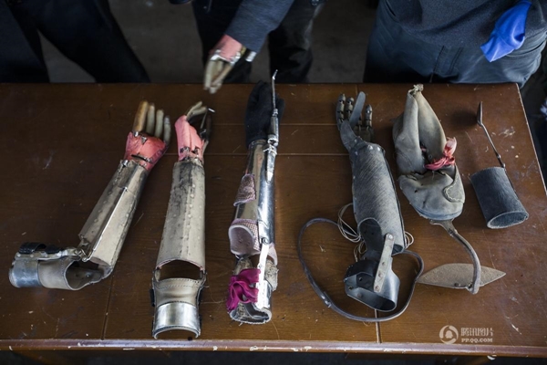 แขนเทียม แขนเทียม