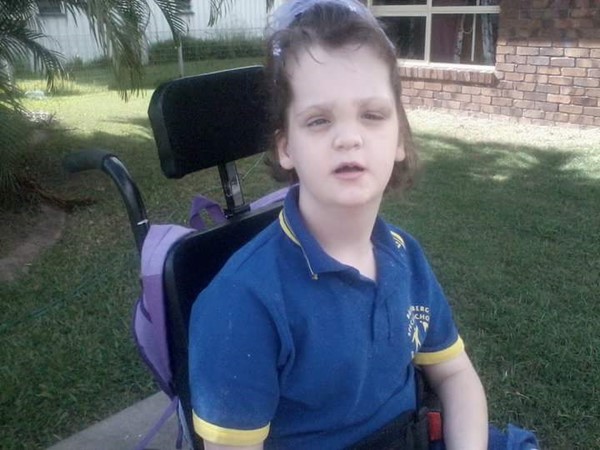 Proteus Syndrome Proteus Syndrome