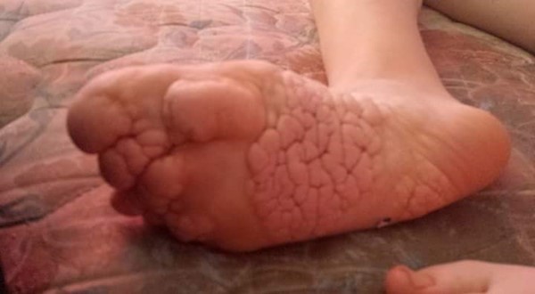 Proteus Syndrome Proteus Syndrome