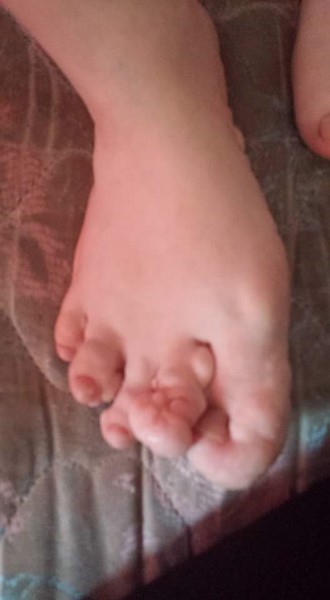 Proteus Syndrome Proteus Syndrome