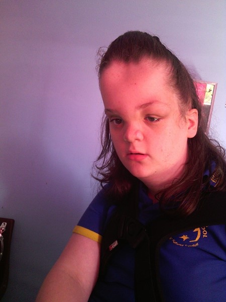 Proteus Syndrome Proteus Syndrome