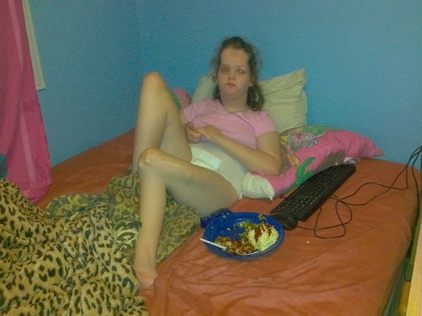 Proteus Syndrome Proteus Syndrome