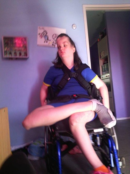 Proteus Syndrome Proteus Syndrome