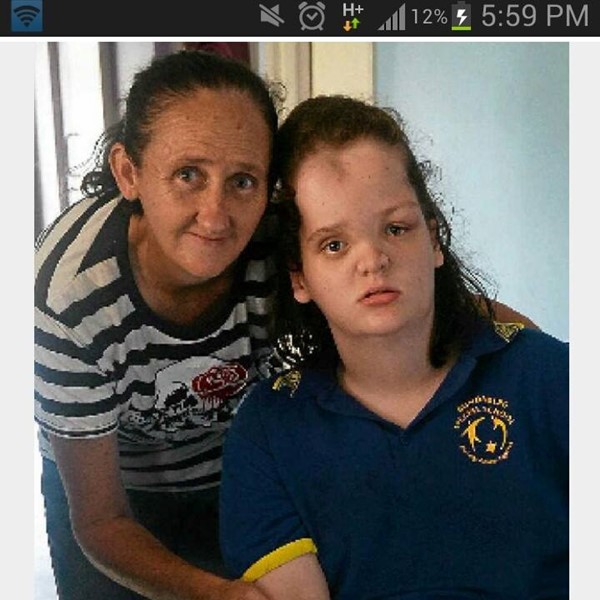 Proteus Syndrome Proteus Syndrome