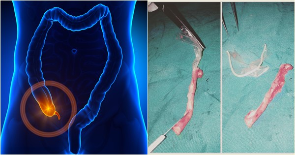 สาวโร่หาหมอเพราะปวดท้องรุนแรง พบต้นเหตุมีเศษถุงยางอนามัยติดในไส้ติ่ง สาวโร่หาหมอเพราะปวดท้องรุนแรง พบต้นเหตุมีเศษถุงยางอนามัยติดในไส้ติ่ง