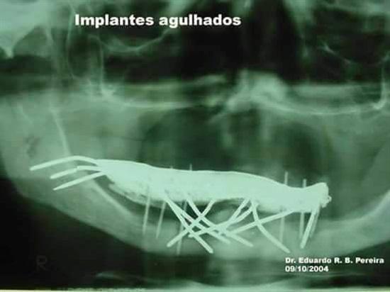 ฟันปลอมเถื่อน ฟันปลอมเถื่อน