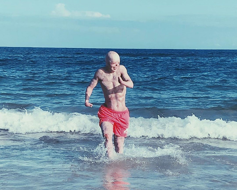 เหยื่อถูกไฟคลอก คอสเพลย์ เหยื่อถูกไฟคลอก คอสเพลย์