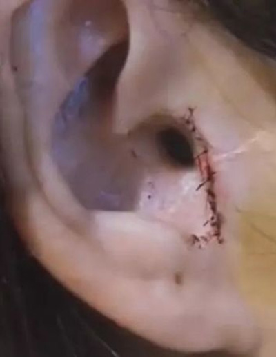 สาวทำศัลยกรรม สาวทำศัลยกรรม