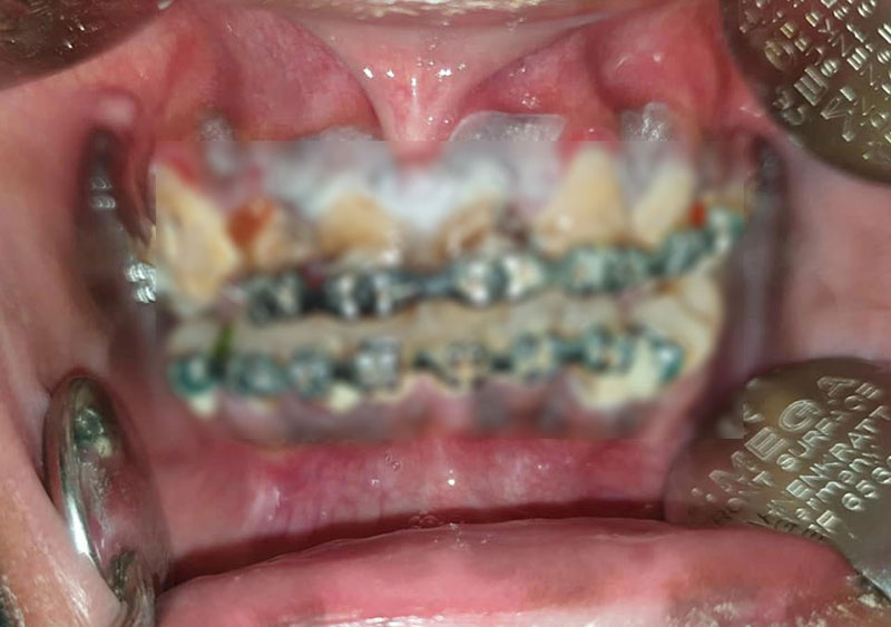 สาวจัดฟันแฟชั่น สาวจัดฟันแฟชั่น