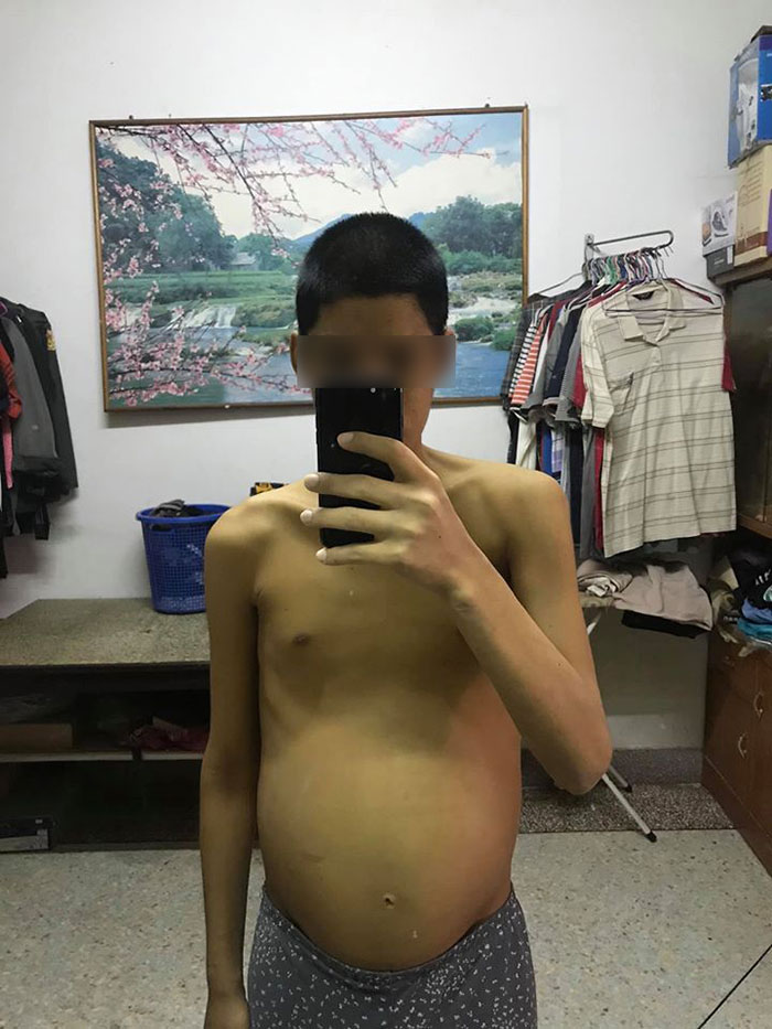 โรคตับแข็ง โรคตับแข็ง