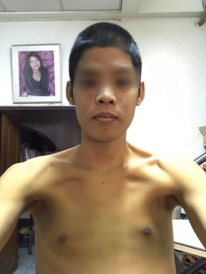 โรคตับแข็ง โรคตับแข็ง