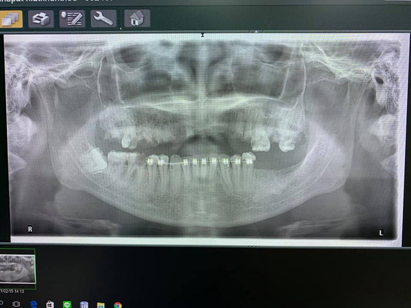 ดัดฟันแฟชั่น ดัดฟันแฟชั่น