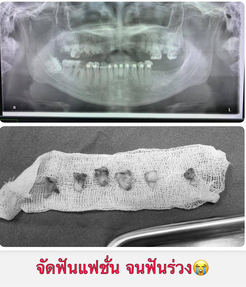 ดัดฟันแฟชั่น ดัดฟันแฟชั่น