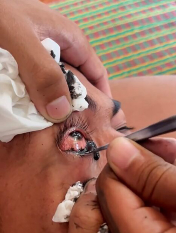 สักขอบตา สักขอบตา