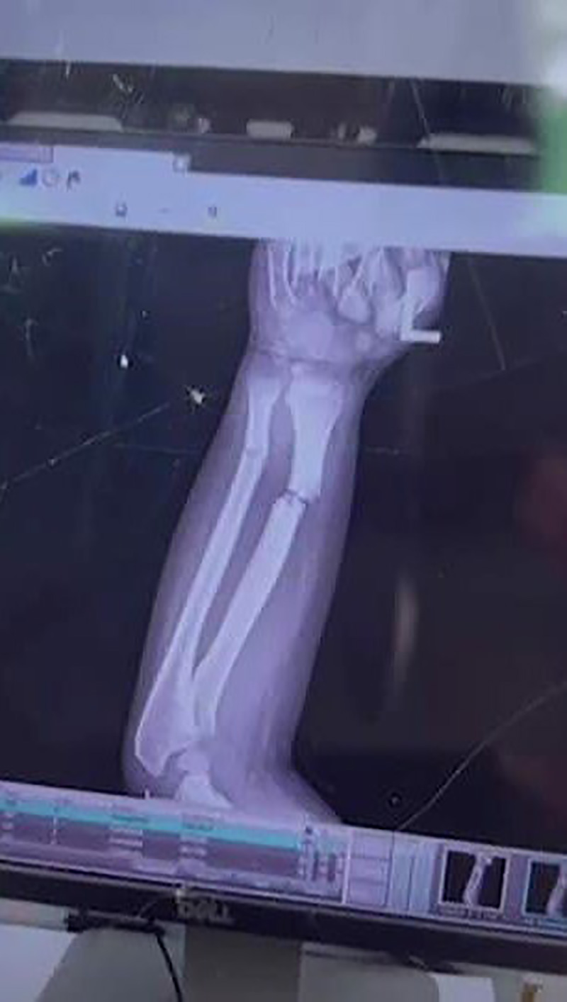 เด็ก 5 ขวบ แขนหัก ครูไม่พาไป รพ. เด็ก 5 ขวบ แขนหัก ครูไม่พาไป รพ.