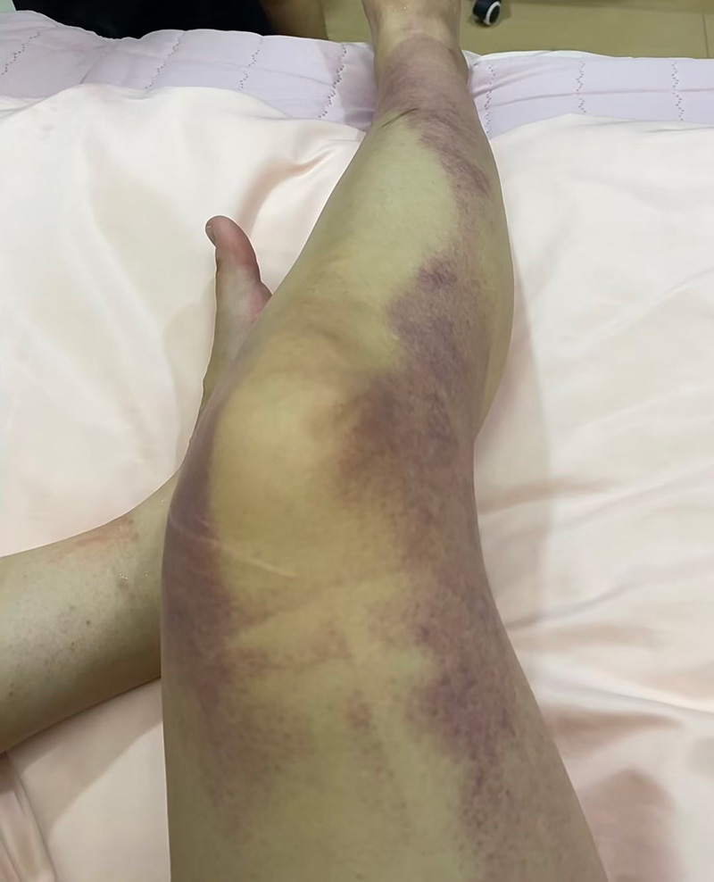 นศ. เปิดสภาพขาหลังอัดอยู่ในอิแทวอน นศ. เปิดสภาพขาหลังอัดอยู่ในอิแทวอน