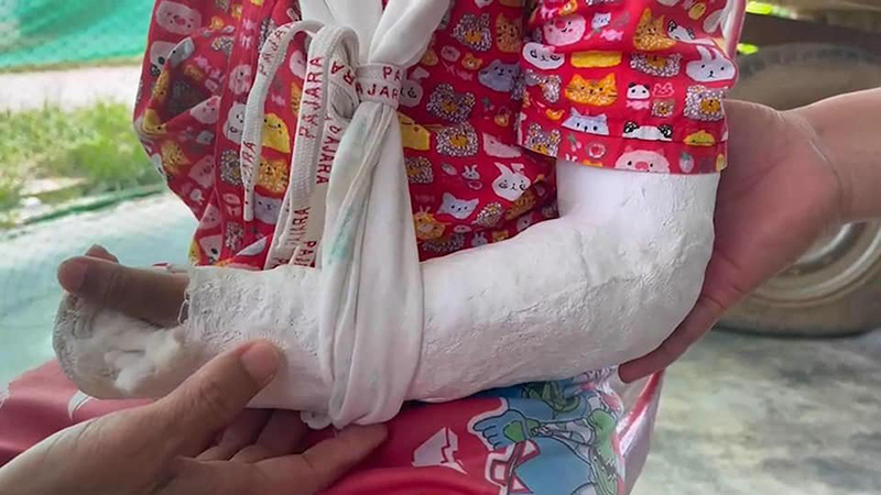 เด็ก 5 ขวบ แขนหัก ครูไม่พาไป รพ. เด็ก 5 ขวบ แขนหัก ครูไม่พาไป รพ.