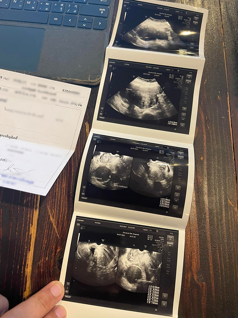 สาวปวดท้องคิดว่าโรคกระเพาะ ผงะ เจอซีสต์ในรังไข่ สาวปวดท้องคิดว่าโรคกระเพาะ ผงะ เจอซีสต์ในรังไข่