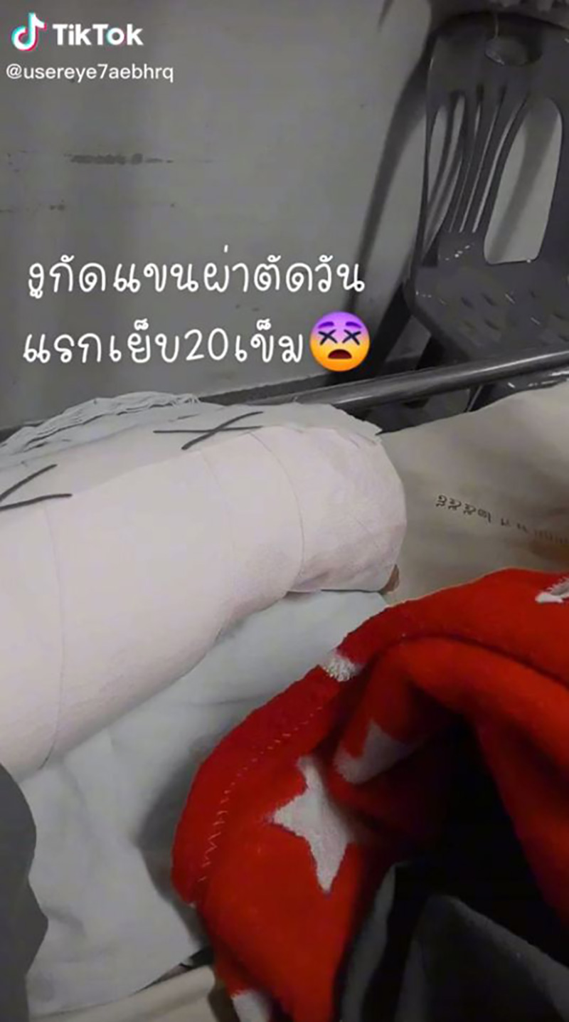 สาวแชร์ประสบการณ์ เกือบต้องตัดแขนเพราะงูเขียวหางไหม้ สาวแชร์ประสบการณ์ เกือบต้องตัดแขนเพราะงูเขียวหางไหม้