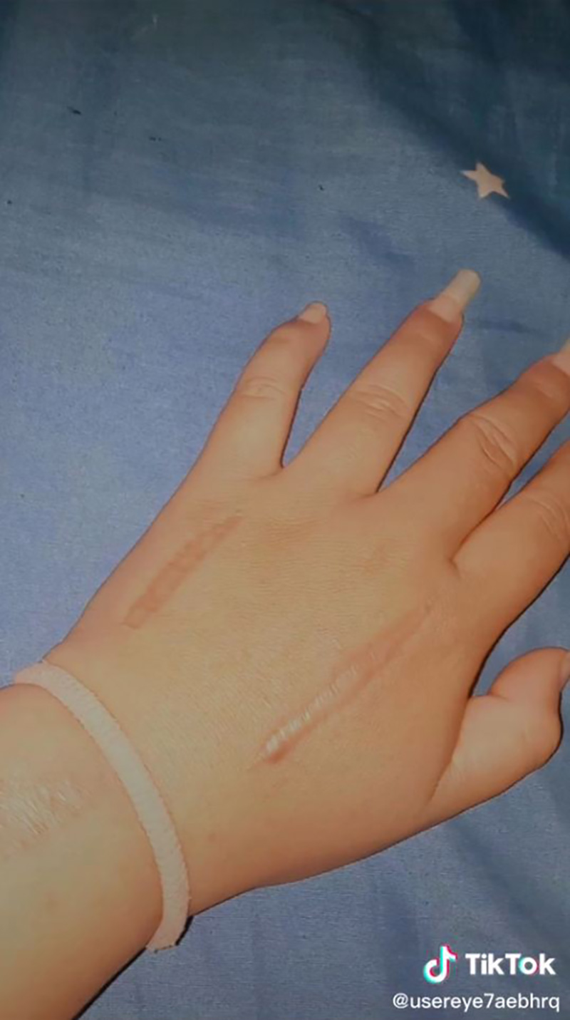 สาวแชร์ประสบการณ์ เกือบต้องตัดแขนเพราะงูเขียวหางไหม้ สาวแชร์ประสบการณ์ เกือบต้องตัดแขนเพราะงูเขียวหางไหม้