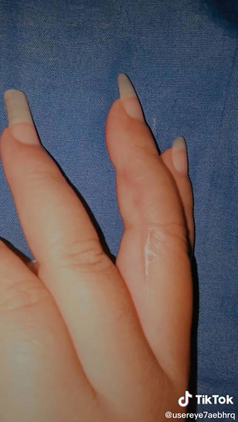 สาวแชร์ประสบการณ์ เกือบต้องตัดแขนเพราะงูเขียวหางไหม้ สาวแชร์ประสบการณ์ เกือบต้องตัดแขนเพราะงูเขียวหางไหม้