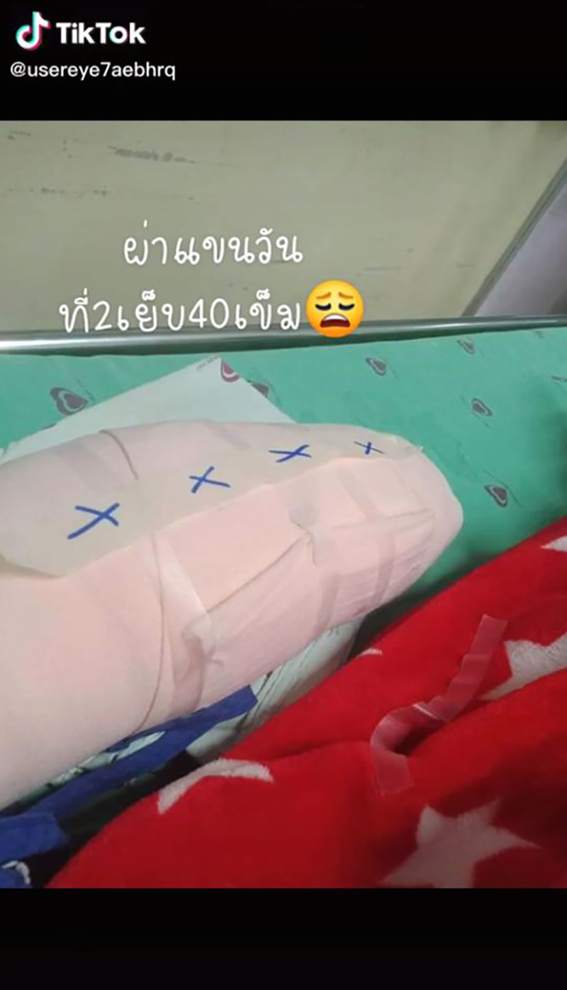 สาวแชร์ประสบการณ์ เกือบต้องตัดแขนเพราะงูเขียวหางไหม้ สาวแชร์ประสบการณ์ เกือบต้องตัดแขนเพราะงูเขียวหางไหม้