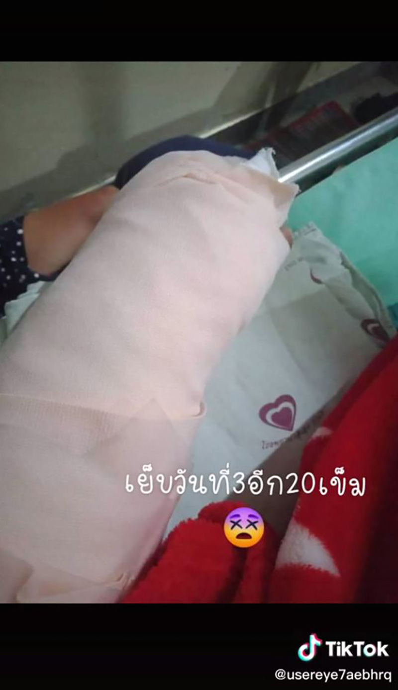 สาวแชร์ประสบการณ์ เกือบต้องตัดแขนเพราะงูเขียวหางไหม้ สาวแชร์ประสบการณ์ เกือบต้องตัดแขนเพราะงูเขียวหางไหม้