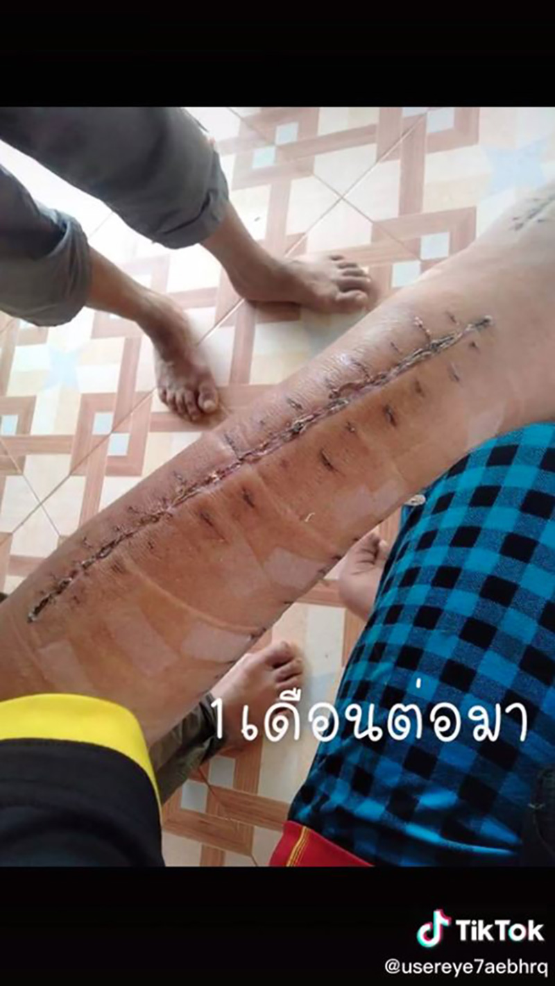 สาวแชร์ประสบการณ์ เกือบต้องตัดแขนเพราะงูเขียวหางไหม้ สาวแชร์ประสบการณ์ เกือบต้องตัดแขนเพราะงูเขียวหางไหม้