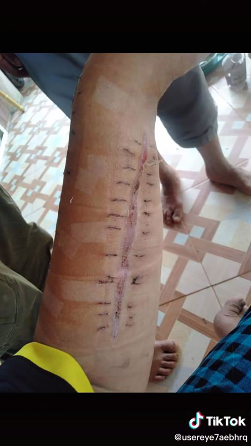 สาวแชร์ประสบการณ์ เกือบต้องตัดแขนเพราะงูเขียวหางไหม้ สาวแชร์ประสบการณ์ เกือบต้องตัดแขนเพราะงูเขียวหางไหม้