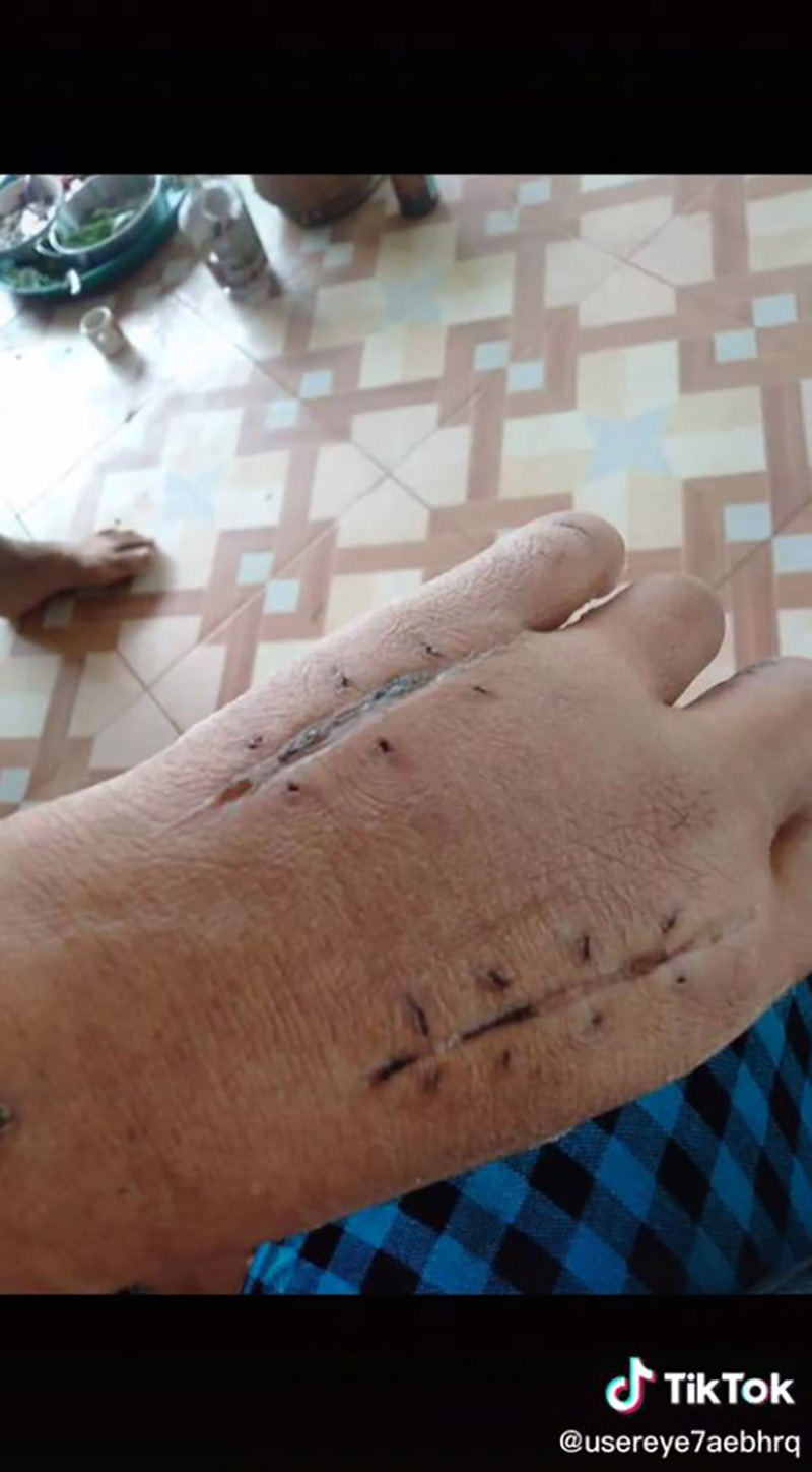 สาวแชร์ประสบการณ์ เกือบต้องตัดแขนเพราะงูเขียวหางไหม้ สาวแชร์ประสบการณ์ เกือบต้องตัดแขนเพราะงูเขียวหางไหม้