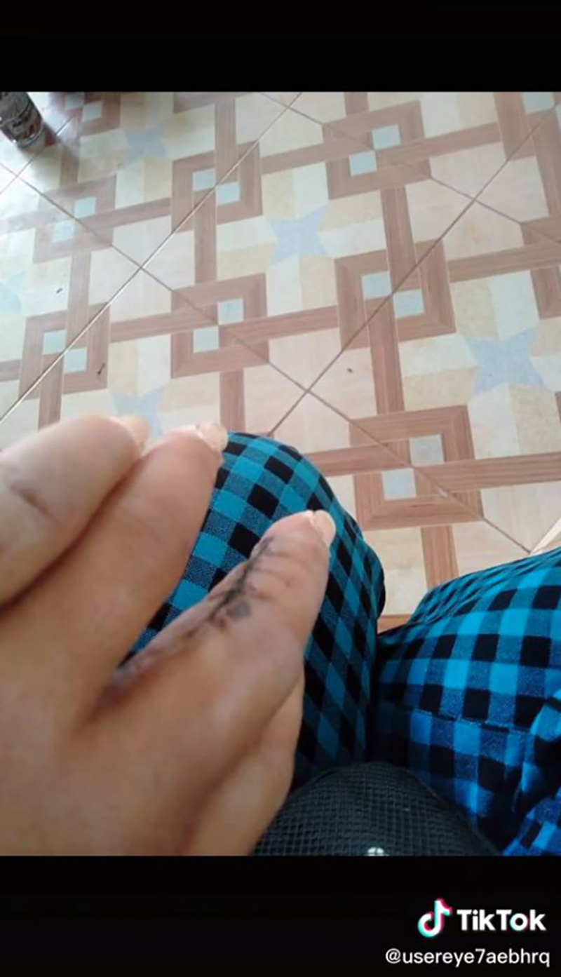 สาวแชร์ประสบการณ์ เกือบต้องตัดแขนเพราะงูเขียวหางไหม้ สาวแชร์ประสบการณ์ เกือบต้องตัดแขนเพราะงูเขียวหางไหม้