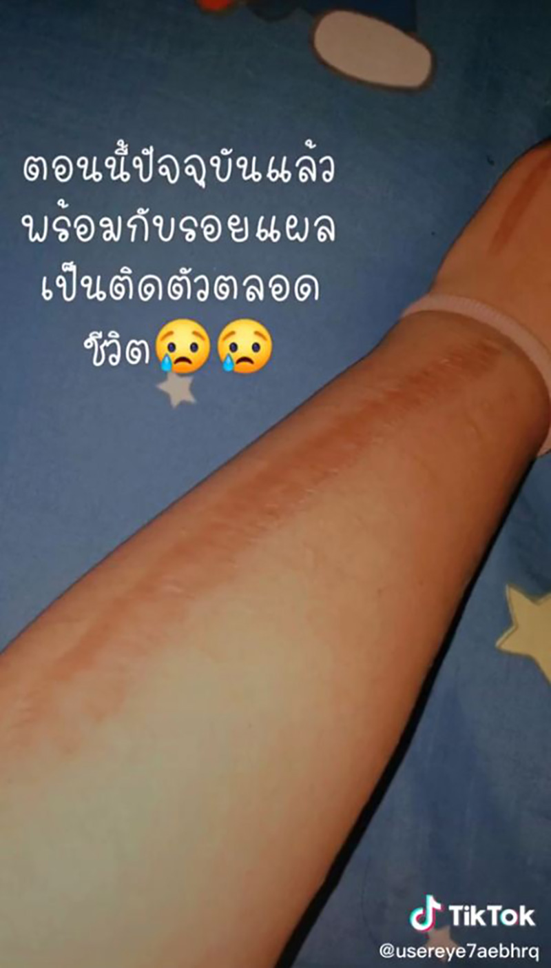 สาวแชร์ประสบการณ์ เกือบต้องตัดแขนเพราะงูเขียวหางไหม้ สาวแชร์ประสบการณ์ เกือบต้องตัดแขนเพราะงูเขียวหางไหม้