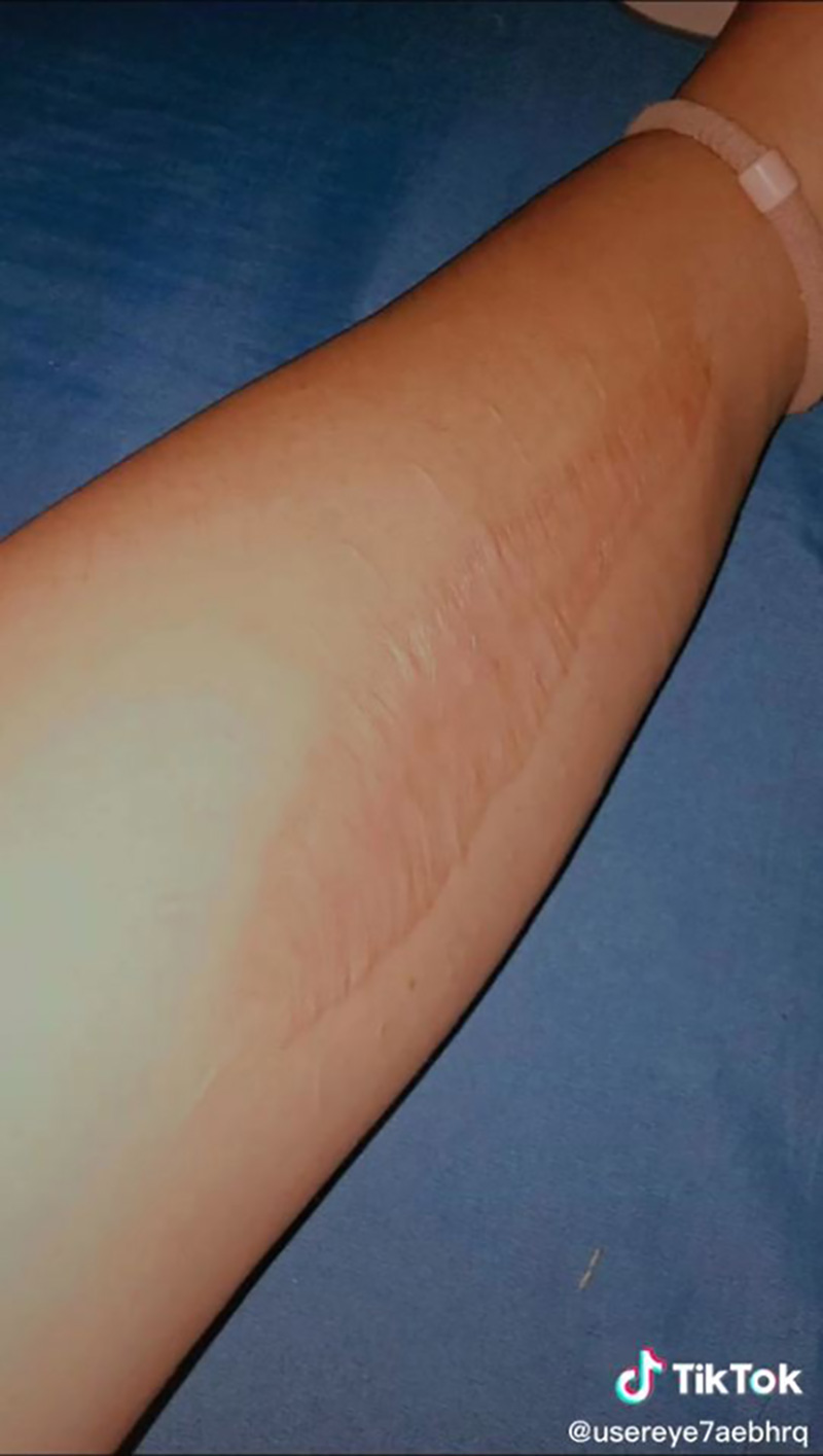 สาวแชร์ประสบการณ์ เกือบต้องตัดแขนเพราะงูเขียวหางไหม้ สาวแชร์ประสบการณ์ เกือบต้องตัดแขนเพราะงูเขียวหางไหม้