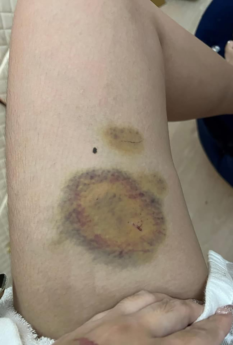 ไฮโซสาวถูกอดีตสามีลูกชายดีเจดังทำร้าย ไฮโซสาวถูกอดีตสามีลูกชายดีเจดังทำร้าย